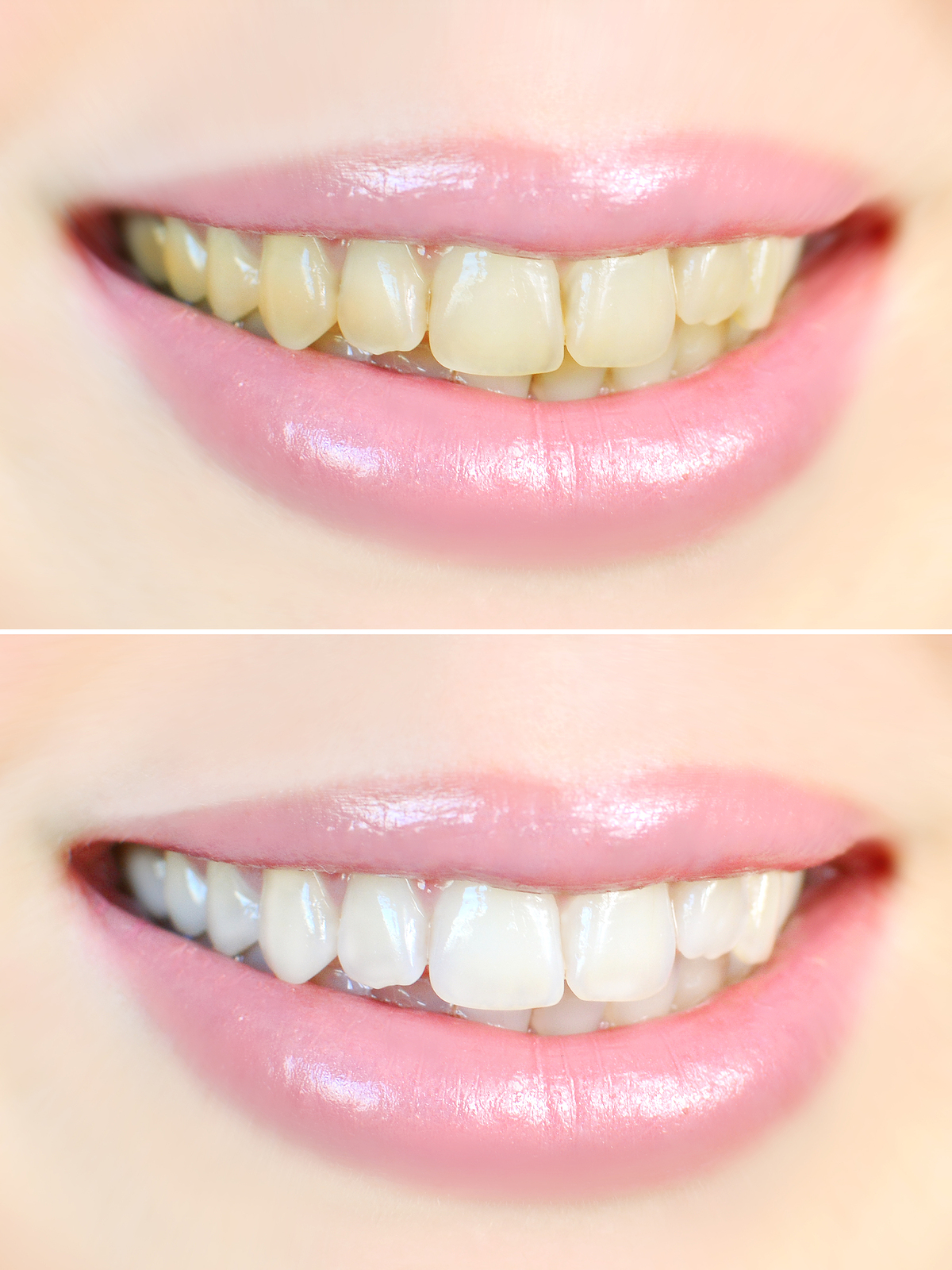 Teeth Whitening: Way to a Bright Smile