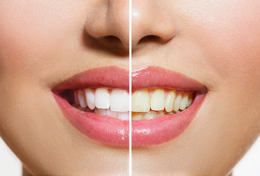 Achieve a Brighter Smile with Professional Teeth Whitening in Chicago, IL